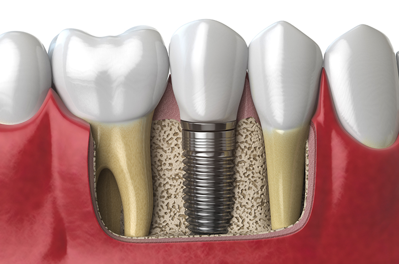 anatomy-of-healthy-teeth-and-tooth-dental-implant-PAF6ZMW anatomy-of-healthy-teeth-and-tooth-dental-implant-PAF6ZMW